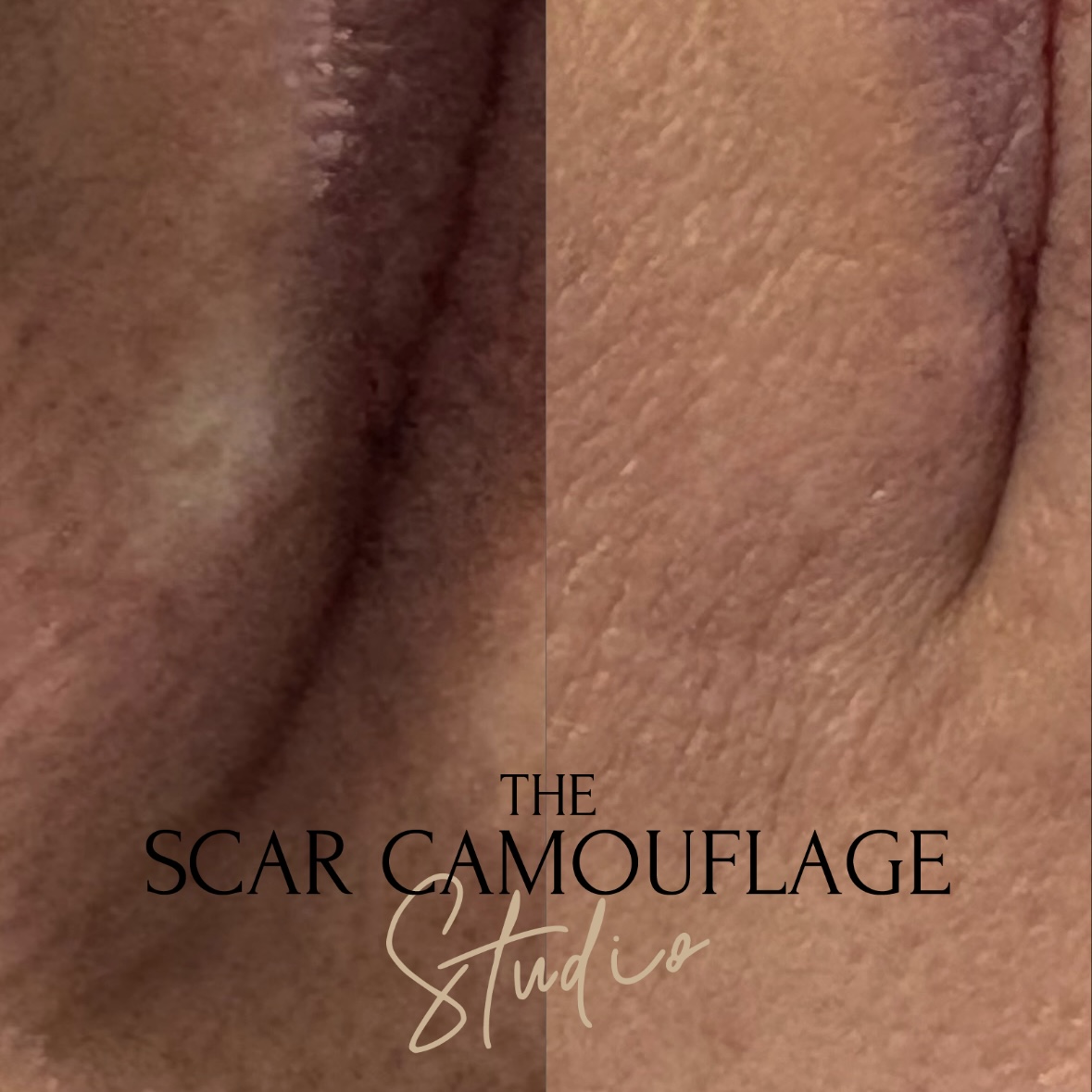 Medical Tattooist | The Scar Camouflage Studio gallery image 3