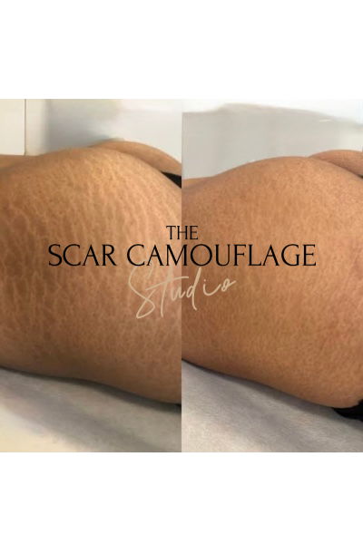 Medical Tattooist | The Scar Camouflage Studio gallery image 2