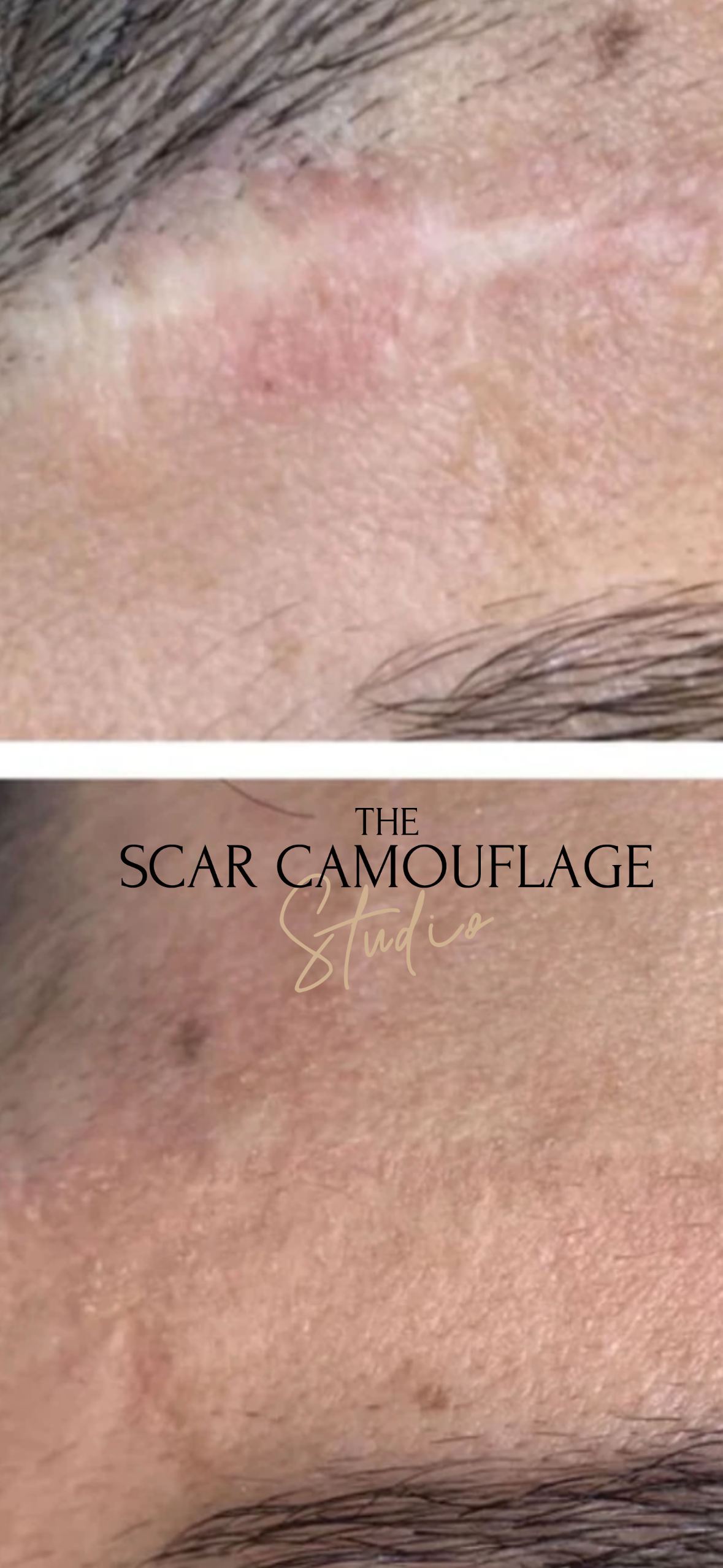 Medical Tattooist | The Scar Camouflage Studio gallery image 4