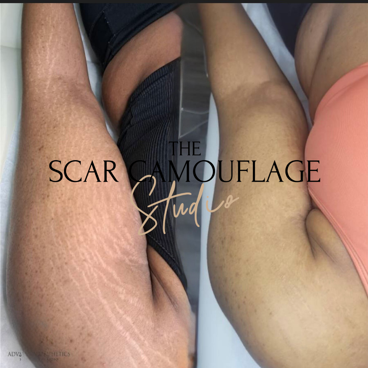 Medical Tattooist | The Scar Camouflage Studio gallery image 1